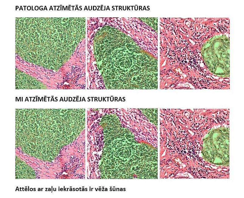 Projektā AIDA veiksmīgi apmāca mākslīgā intelekta modeli, tagad spēj atpazīt vēža šūnas ar 92% precizitāti